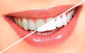 أنواع عمليات تجميل الأسنان 2024