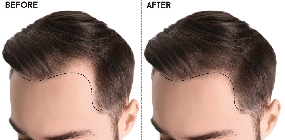 احجز الآن عملية زراعة شعر الخط الأمامي مع موقع عمليات لاستعادة إطار وجهك وجمالك الطبيعي