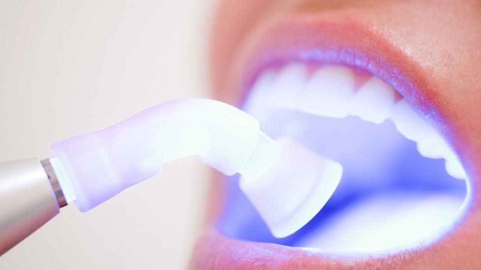 ما هي مميزات عملية تبييض الأسنان؟