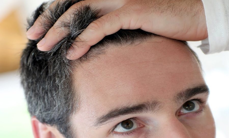 فوائد زراعة الشعر