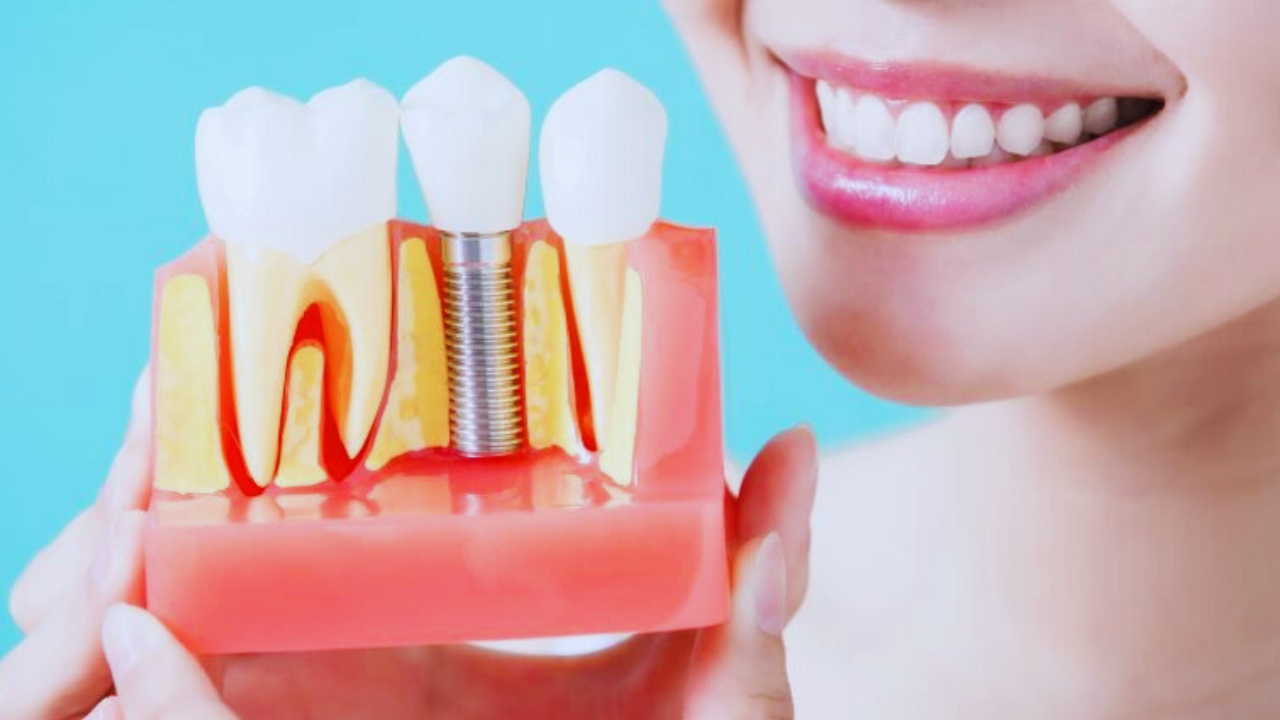 زراعة الأسنان في الفك العلوي